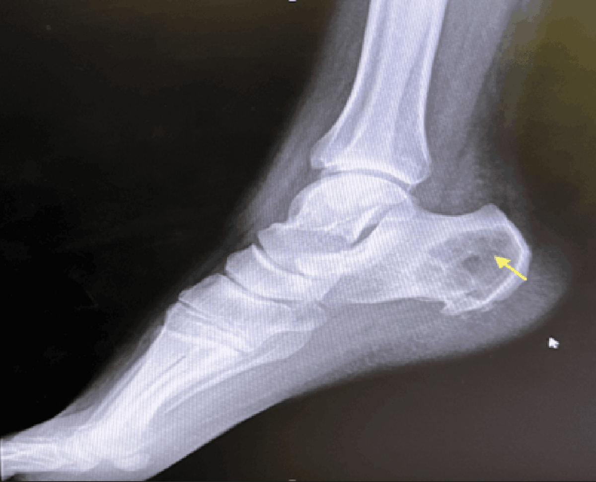 MohammedJanajri's tweet photo. Our newly published case report " Solitary Plasmacytoma in the Calcaneus" Check it out! 
https://t.co/Rv9Ba5BA8A
#MedTwitter https://t.co/fIDZGIWZpL