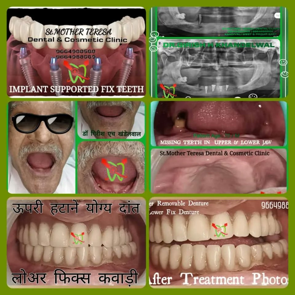 Contact us on :- 9664988588 | 9664988589 watsapp/call

#implant #implantdentistry #dentalreels #implantsupporteddentures #reelsfb #implantdentist #indiareels #missingteeth  #mumbaireels #kandivali #kandivaliwest #kandivalieast #kandivali101 #thakurcomplex #thakurvillage