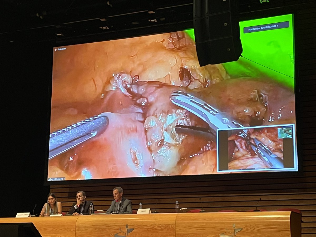 Después de la presentación de <a href="/hermsdani/">Daniel Herms</a> sobre el manejo del desgarro del pouch gástrico en un bypass, saltamos a las cirugías en directo.

Reversión de bypass por <a href="/santiazagra/">Juan Santiago Azagra</a> y reversión de SADI-S por <a href="/CirugiaPernaute/">Cirugía bariátrica Sánchez-Pernaute</a>, moderados por el Dr. Ferrer y <a href="/drvilallonga/">RAMON VILALLONGA</a>.

#SECO2023