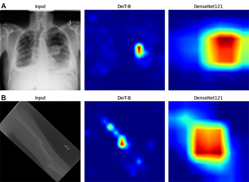 🥳 Congratulations to @SamSantomartino for receiving an @RSNA Medical Student Research Grant! Looking forward to building on our recent papers in @radiology_rsna and @Radiology_AI to tackle #fairness issues in #AI for #Radiology using vision transformers. @UM2ii @DrexelMedicine