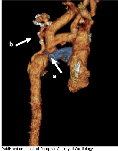 ESC_Journals's tweet image. Severe aortic coarctation in a young pregnant patient - how was it managed? bit.ly/3BifMy8

#EHJCaseReports #WhyCCT @aayshacader @KardiologieHH @ANazmiCalik  @EHJCREiC @TJ_Yeo  @Phiso_de @FarhanaAra