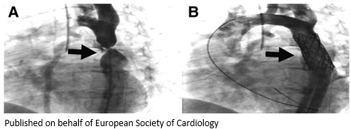 ESC_Journals's tweet image. Severe aortic coarctation in a young pregnant patient - how was it managed? bit.ly/3BifMy8

#EHJCaseReports #WhyCCT @aayshacader @KardiologieHH @ANazmiCalik  @EHJCREiC @TJ_Yeo  @Phiso_de @FarhanaAra