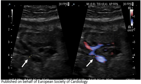 ESC_Journals's tweet image. Severe aortic coarctation in a young pregnant patient - how was it managed? bit.ly/3BifMy8

#EHJCaseReports #WhyCCT @aayshacader @KardiologieHH @ANazmiCalik  @EHJCREiC @TJ_Yeo  @Phiso_de @FarhanaAra