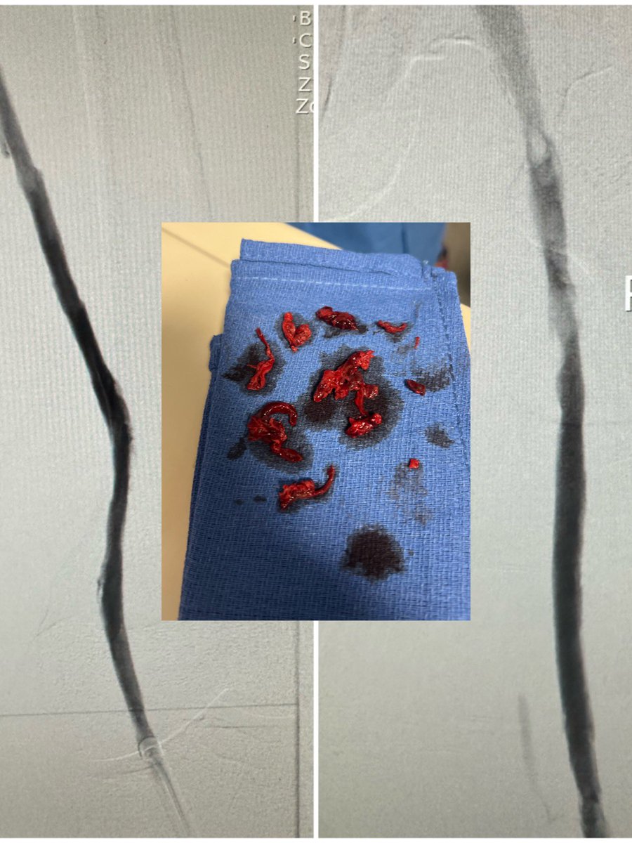 drochohan's tweet photo. Mixed DVT @PenVascular FLASH <200cc EBL. Nice to see options for DVT growing making the procedure faster and easier. @SIR_ECS @SIRRFS @SIRspecialists #irad #vascular #CardioTwitter #MedTwitter https://t.co/zR35YOaUmv