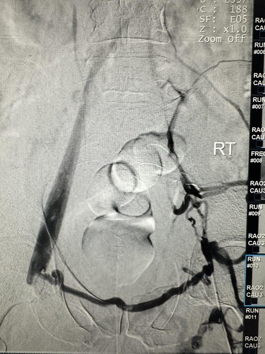 drochohan's tweet photo. Mixed DVT @PenVascular FLASH <200cc EBL. Nice to see options for DVT growing making the procedure faster and easier. @SIR_ECS @SIRRFS @SIRspecialists #irad #vascular #CardioTwitter #MedTwitter https://t.co/zR35YOaUmv
