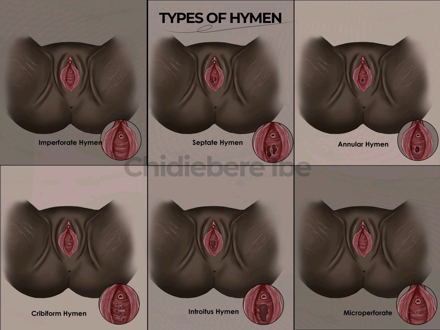 virgin vagina Hymen is a thin  piece of tissue located at the opening of the vagina. d hymen needs to be  open to allow menstrual blood