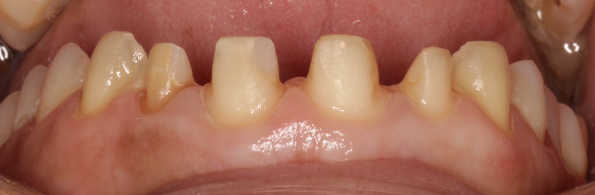 HindMM_'s tweet photo. Teeth preparation and provisional crowns  ✨ https://t.co/gvjncIL2rZ