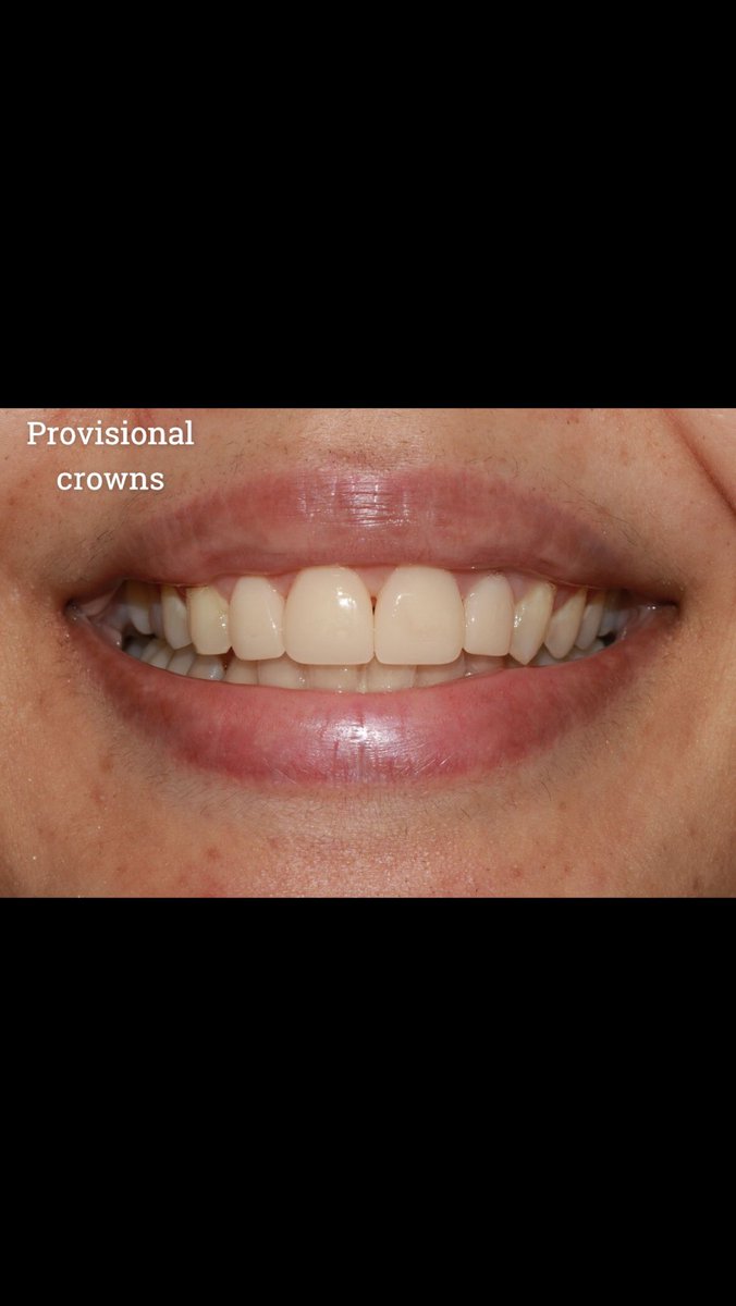 HindMM_'s tweet photo. Teeth preparation and provisional crowns  ✨ https://t.co/gvjncIL2rZ
