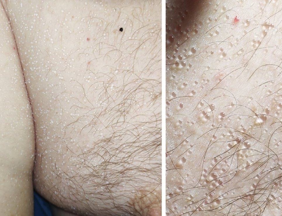 anadelgadomq's tweet image. ¿Habéis hecho ya el último #imagechallenge de @nejm? ¿Qué os parecen estas lesiones asintomáticas, como "ampollitas de agua", que aparecieron de forma aguda en tronco y brazos de este paciente? 👇🏼