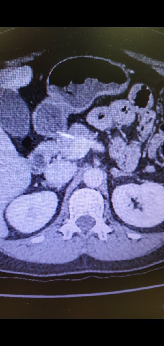 davidscolon's tweet photo. @drkeithsiau I'm amazed how some people can swallow huge bones. This one was stuck in the pancreatic head. Retrieved endoscopically. 🙉. https://t.co/LdaahAuX33