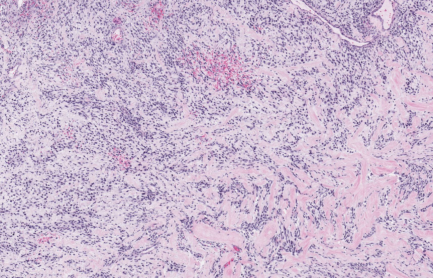 Brendan Dickson, MD on Twitter "MALIGNANT PERIPHERAL NERVE SHEATH