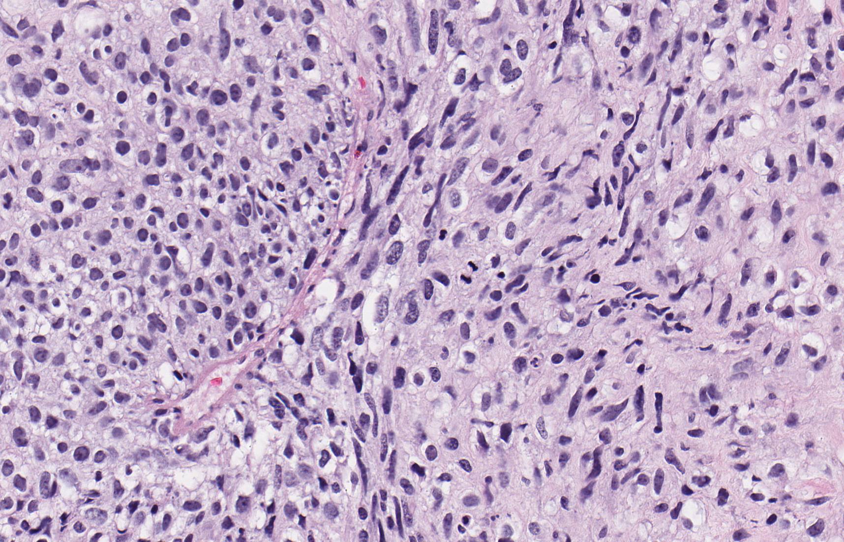 Brendan Dickson, MD on Twitter "MALIGNANT PERIPHERAL NERVE SHEATH