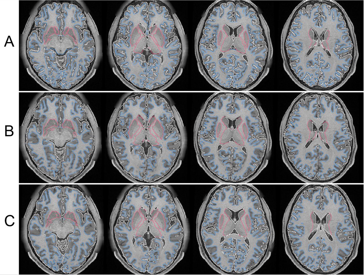 FangChengYeh's tweet photo. Calling all brain enthusiasts!
Here's a blind evaluation of 3 different brain segmentation methods to determine the most accurate one!
Reply with answers like A>B>C or A=B>C. The methods will be disclosed afterward.
Let's do some #brainsegmentation! https://t.co/CAhVRX0Wvn