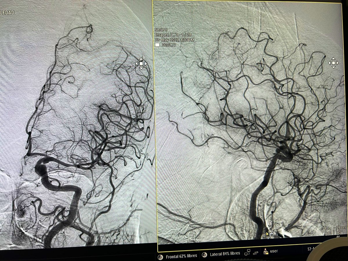 RobertoCorrea__'s tweet photo. Endovascular mechanical thrombectomy. Solumbra technique for the first pass, proximal left MCA-2 occlusion and ICA aneurysm (communicating segment) diagnosed at the thrombectomy. Thrombus extraction by pinching technique. First pass effect, TICI 3. @VirTauli @NicoRomeroMD https://t.co/SbEjpHXdFt