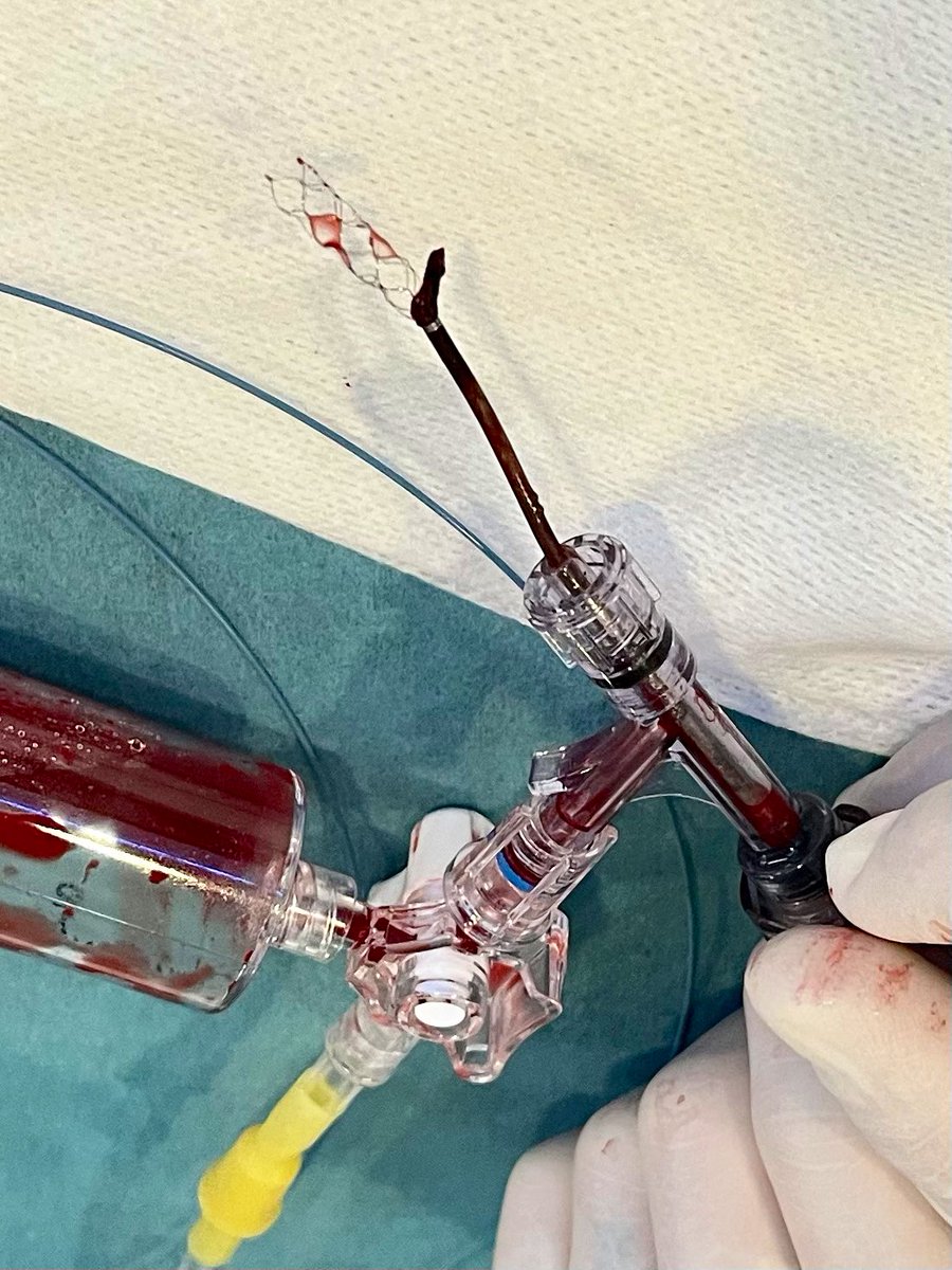 RobertoCorrea__'s tweet photo. Endovascular mechanical thrombectomy. Solumbra technique for the first pass, proximal left MCA-2 occlusion and ICA aneurysm (communicating segment) diagnosed at the thrombectomy. Thrombus extraction by pinching technique. First pass effect, TICI 3. @VirTauli @NicoRomeroMD https://t.co/SbEjpHXdFt