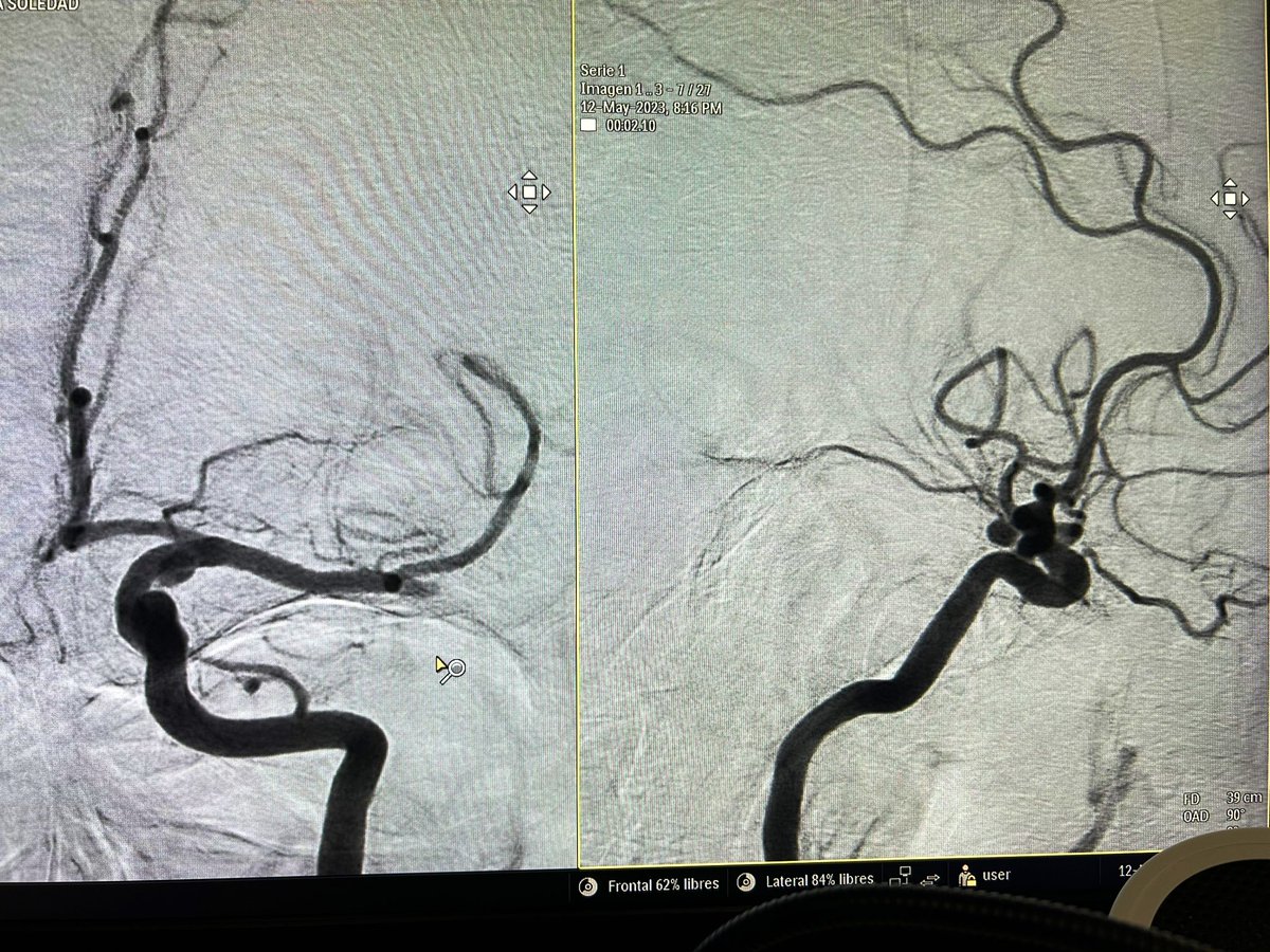 RobertoCorrea__'s tweet photo. Endovascular mechanical thrombectomy. Solumbra technique for the first pass, proximal left MCA-2 occlusion and ICA aneurysm (communicating segment) diagnosed at the thrombectomy. Thrombus extraction by pinching technique. First pass effect, TICI 3. @VirTauli @NicoRomeroMD https://t.co/SbEjpHXdFt