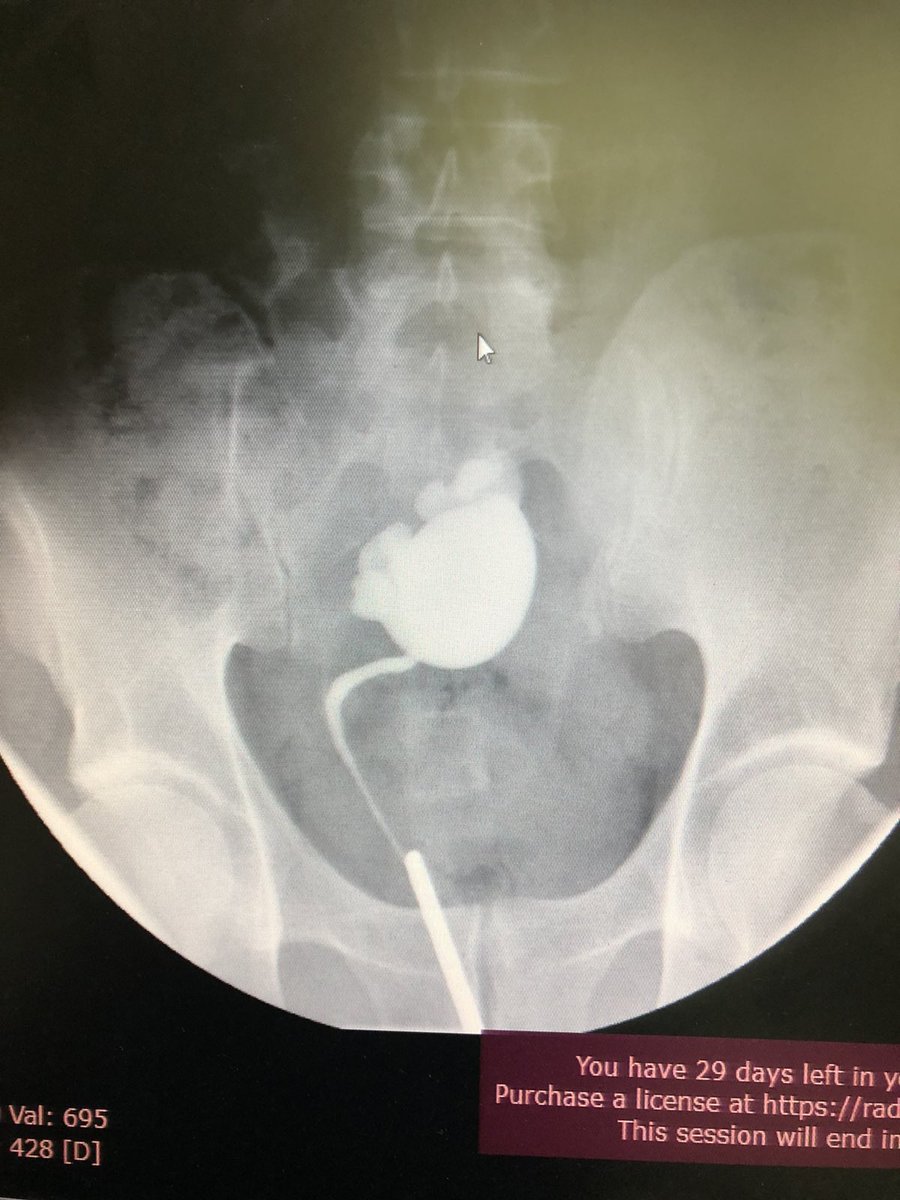 Fahredin17's tweet photo. Open Pyeloplasty of a Pelvic Kidney with Ureteropelvic Junction Obstruction. 

VitaHospital, Prishtina https://t.co/QuXwLKCnAr
