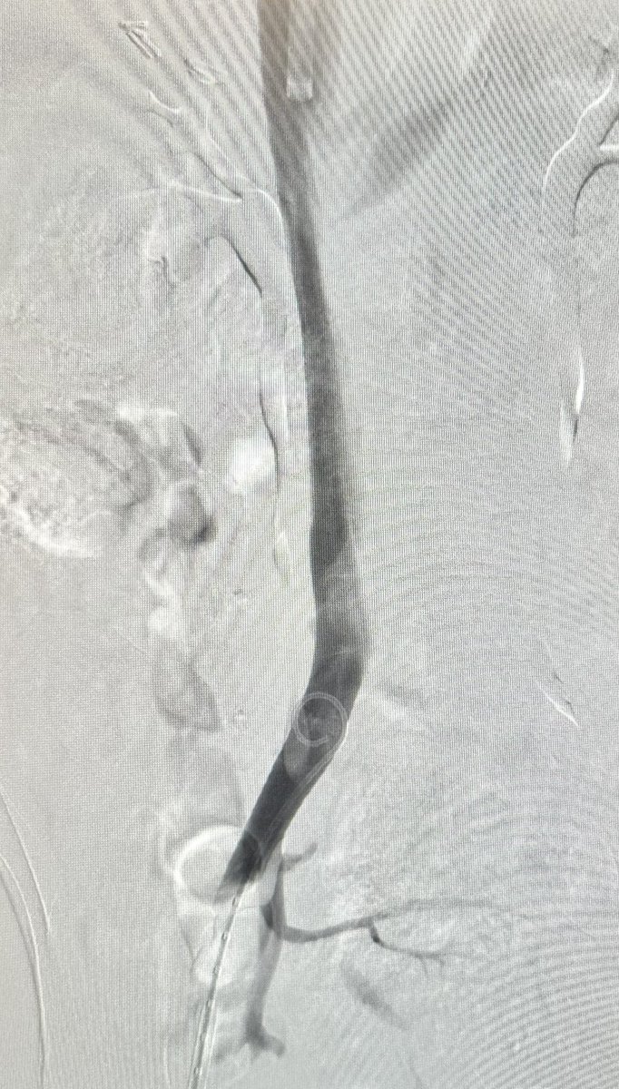 5/ final venogram with no residual contrast extravasation
