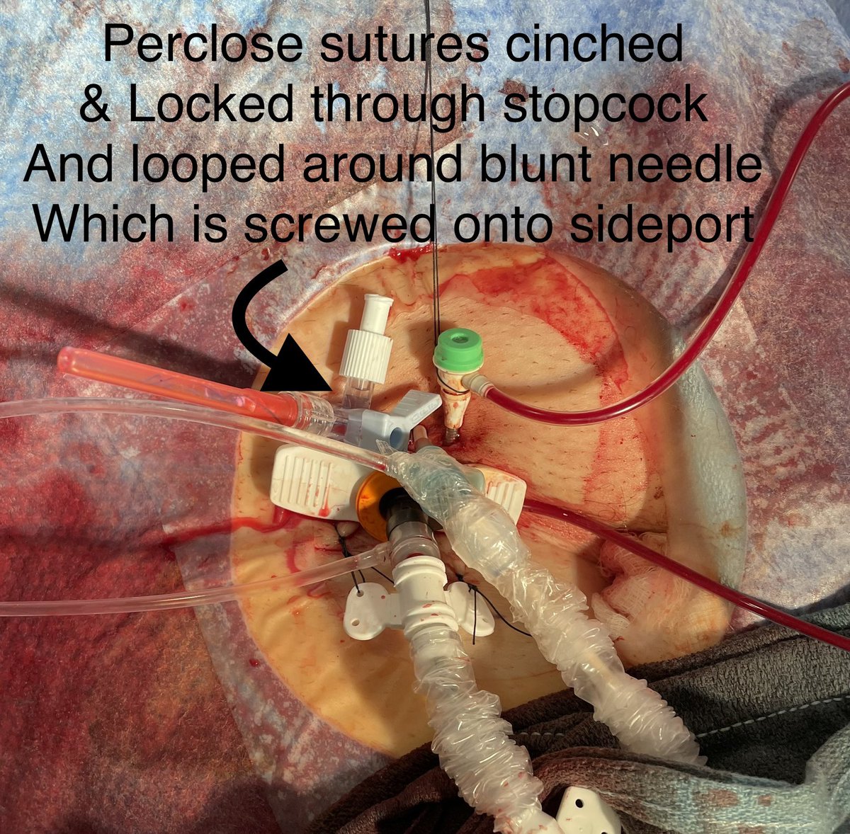HadyLichaaMD's tweet photo. @DrAmirKaki @agtruesdell @RajTayalMD @ziadalinyc @SMPatelMD @DBCardsFellows @ChirdeepPatel @AdrianMercadoMD @MagdyHannaMD @SripalBangalore @Babar_Basir @DrAmirKaki i see you like the #StopCockPerclose technique to tighten the arteriotomy site around #LargeBoreSheath. Do u wrap the sutures in a tegaderm or towel? I complement it with a #BluntNeedle screwed onto the sideport. I find it pretty sterile & simple for CCU RNs https://t.co/nw72O9V43m