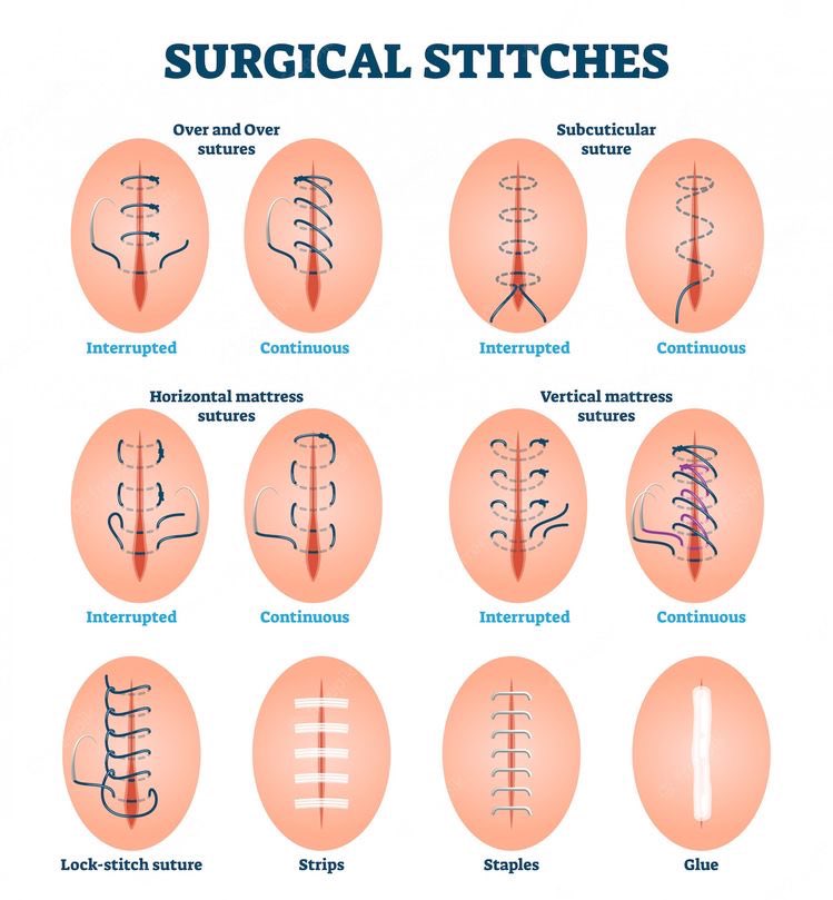 OGdukeneurosurg's tweet photo. Other suture techniques https://t.co/vgig2rzjFO