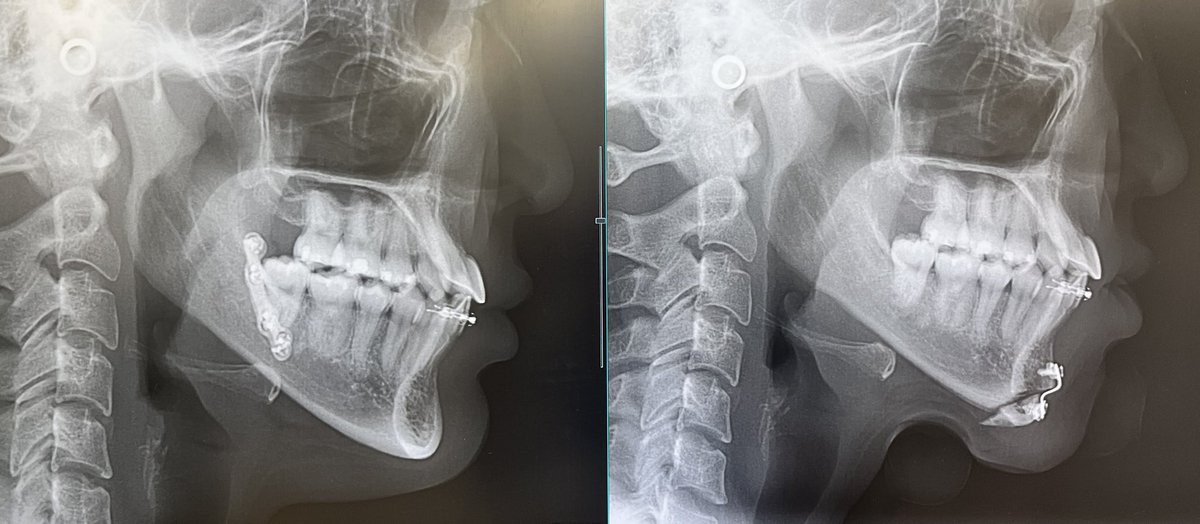 ←術前　術後→
レントゲン見せてもろた🥺
骨だけでみると短くなってる、、
顎長く見えるのは腫れのせいで、オトガイのプレ除去したらさらに滑らかになると思います〜って言われた

とりあえずDT中だから病むのやめる😭‼️早く腫れ引け、、