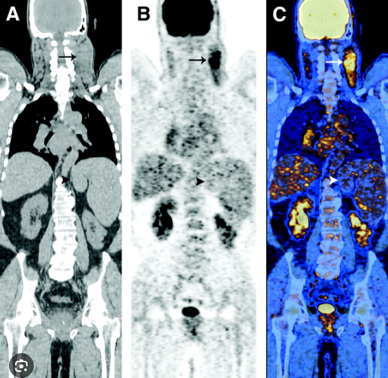 radRounds's tweet photo. Diagnosis?  (source: J Nuc Med) https://t.co/FkDTG0rtAx