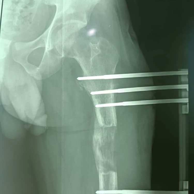 buchi29's tweet photo. M/28 yr old with femur bone loss following a paed/MVA crash. Had bone transport with LRS system over 4 months, currently in the consolidation phase.#limblengtheningsurgery #deformitycorrection #bonetransport #nigerianorthopaedics https://t.co/kEY5mxTKuB