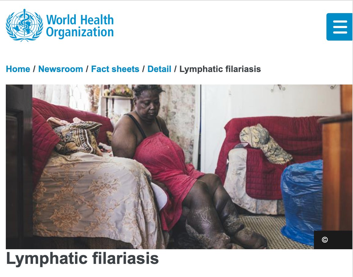 BogochIsaac's tweet photo. Bangladesh has eliminated lymphatic filariasis (sometimes referred to as "elephantiasis"), a significant public health success story.
This is a mosquito transmitted illness causing major swelling, usually in the legs, resulting in profound morbidity.
https://t.co/ArtnVe5mYB https://t.co/WfS4prUAyU