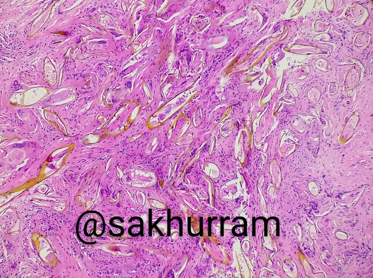 Ali Khurram (@sakhurram) on Twitter photo A pulse granuloma (foreign body reaction) with birefringent vegetable matter in a non-healing tooth socket.
Image 1- under polarised light
Image 2- H&E
#PathTwitter #pathology #oralandmaxillofacialpathology #headandneckpathology <a href="/IHeartHisto/">I Heart Histo</a> A pulse granuloma (foreign body reaction) with birefringent vegetable matter in a non-healing tooth socket.
Image 1- under polarised light
Image 2- H&E
#PathTwitter #pathology #oralandmaxillofacialpathology #headandneckpathology <a href="/IHeartHisto/">I Heart Histo</a>