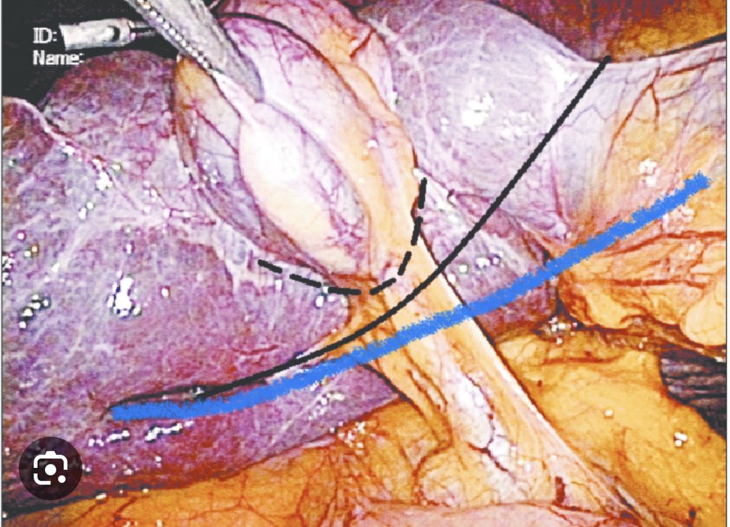 Rouvier’s Sulcus..Geometrically, the word line refers to a line segment in everyday life, which has two points to denote its ends. 
•• it seems everyone has an idea about the “line” of the RS 
• everyone is sure that the medial end of the line is a guide to safety
•• the
