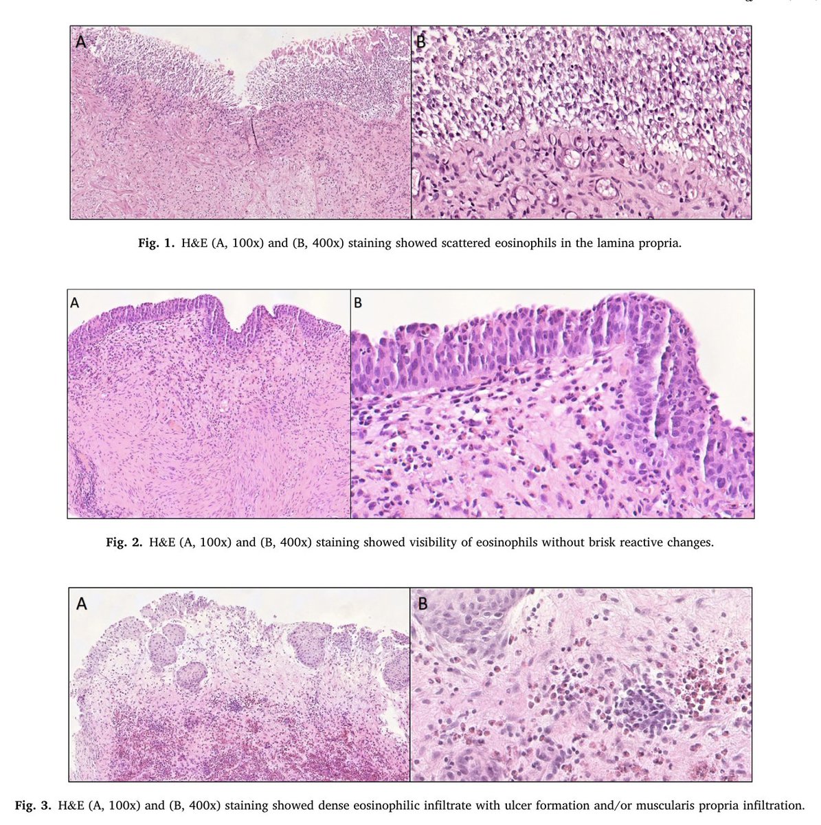 Academic Pathology (@acadpathol) on Twitter photo New in <a href="/AcadPathol/">Academic Pathology</a>: “Correlation of urinary catheterization with histologic grading of eosinophilic cystitis: a single institutional review of 27 cases” doi.org/10.1016/j.acpa… <a href="/AlbanyMed/">Albany Med Health System</a> New in <a href="/AcadPathol/">Academic Pathology</a>: “Correlation of urinary catheterization with histologic grading of eosinophilic cystitis: a single institutional review of 27 cases” doi.org/10.1016/j.acpa… <a href="/AlbanyMed/">Albany Med Health System</a>