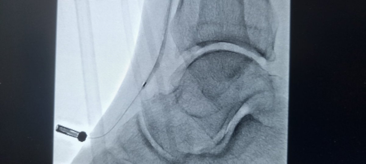 Tip for beginners starting retrograde BTK recanalizations - the torquer is a great tool to anchor the exteriorized wire at the area of pedal puncture. #vascular #limbsalvage #paded #irad #CLTI #vascularsurgery