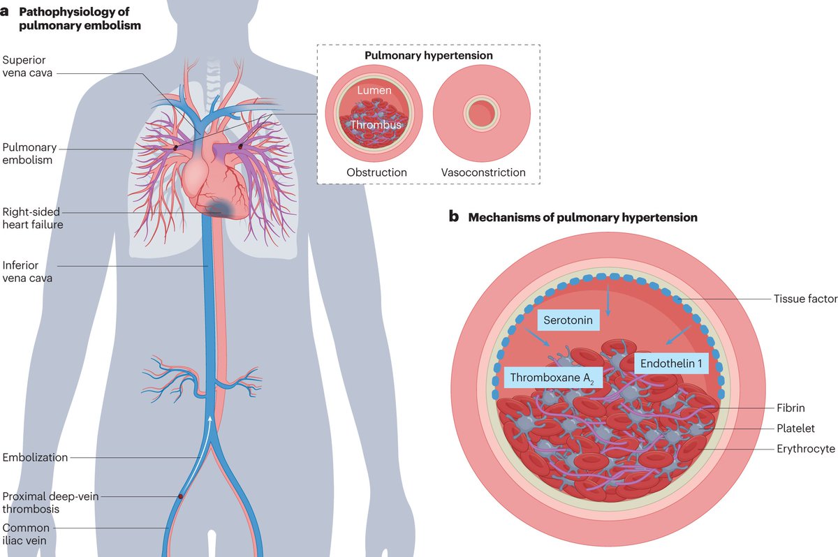 Nature Reviews Cardiology (@natrevcardiol) on Twitter photo In our latest Review, <a href="/FelixMahfoud/">Felix Mahfoud</a> et al. discuss interventional therapies for pulmonary embolism. Check it out here: rdcu.be/db6Dd In our latest Review, <a href="/FelixMahfoud/">Felix Mahfoud</a> et al. discuss interventional therapies for pulmonary embolism. Check it out here: rdcu.be/db6Dd