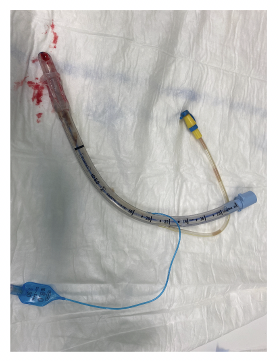 We talk a lot about inability to intubate, but what if you can't EXtubate!?

You'll likely need a multi-disciplinary team to work through this one!

<a href="/deirdsconway/">Deirdre</a> 

…-publications.onlinelibrary.wiley.com/doi/full/10.10…