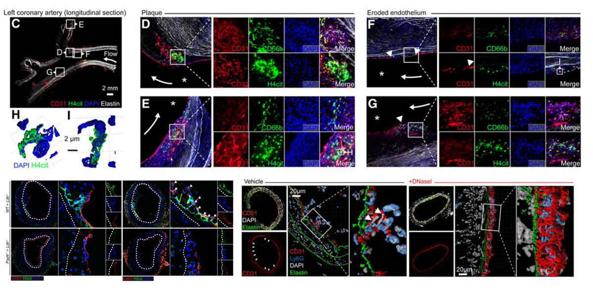 HaoYin20's tweet image. Landmark revisit

Roles of PAD4 &amp;amp; #NETosis in Experimental #Atherosclerosis &amp;amp; Arterial Injury
Implications for #SuperficialErosion

PAD4-/- bone marrow transplant or DNase1⏬flow-induced endothelial loss of🐭carotid intima

Dr Peter Libby lab @CircRes 2018
ahajournals.org/doi/10.1161/CI…