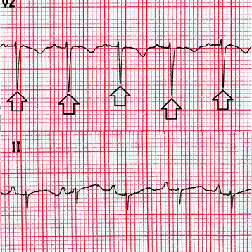 Cardiac Tamponade And Electrical Alternans Dailyem Hot Sex Picture