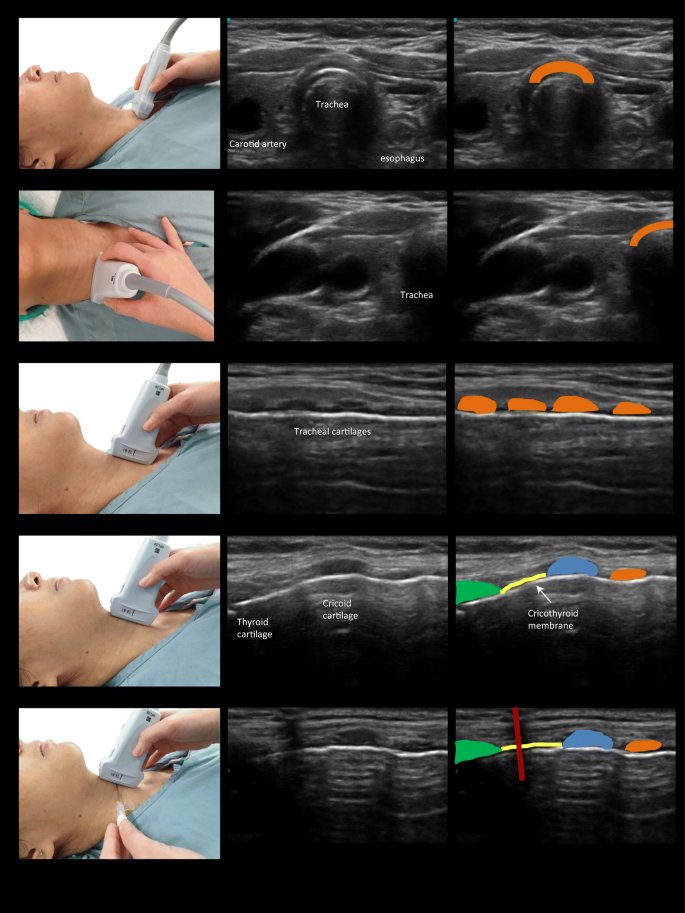 Airway #POCUS 
#anesthesia #FOAMcc #MedTwitter

From:  Zhang, J, et al.  Curr Anesthesiol Rep 10, 317–326 (2020).