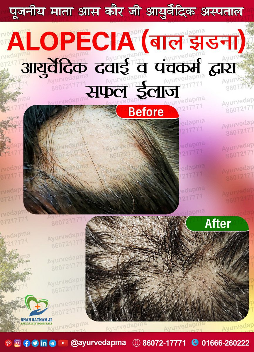 बाल झड़ने का सफल आयुर्वेदिक इलाज। Successful Treatment of Alopecia Areata

#Hair #fall #Loss #HairFall #Hairloss #alopecia #AlopeciaAreata #AYUSH #ayurvedapma #ayurveda #panchakarma #बाल #झड़ना #गिरना #बालटूटना #बालझड़ना #बालगिरना