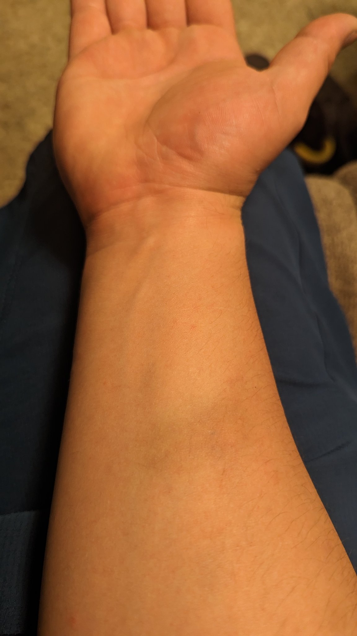 Right forearm bruising from #hemophilia A. https://t.co/3c1cO31jxZ