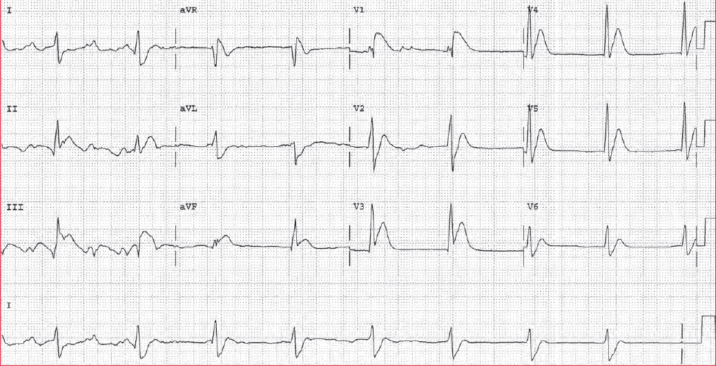 A 64 y.o. woman with diffuse bone pain, fatigue, and a 20-pound weight loss. She is diagnosed with multiple myeloma. An ECG is obtained.
- What abnormality is present?

➡️ Answer and Interpretation: manualofmedicine.com/ecgs/ecg-case-…

#medtwitter #foamed #CardioTwitter