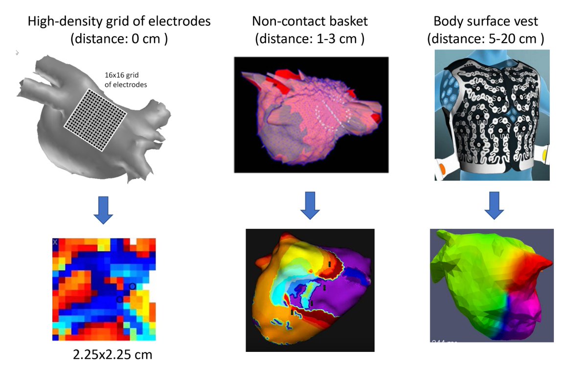 'EPLab Research Works' open source application (@eplabw) on Twitter photo Paradoxes of AF mapping.
3 different mapping modalities with different resolution. Different mapping resolution -> different resolution of the "mechanism story".
HD grid: small wavelets
Intracavitary mapping (<a href="/AcutusMedical/">Acutus Medical</a>): medium waves
Body surface: huge waves
#EPeeps Paradoxes of AF mapping.
3 different mapping modalities with different resolution. Different mapping resolution -> different resolution of the "mechanism story".
HD grid: small wavelets
Intracavitary mapping (<a href="/AcutusMedical/">Acutus Medical</a>): medium waves
Body surface: huge waves
#EPeeps