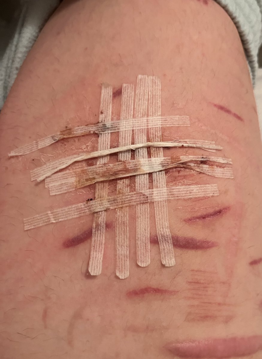 UnPerfect_blue's tweet photo. It’s a few days old now but the doctor did that. Not me. He just slapped them on there and called it a day fr https://t.co/9Sndk4tObK