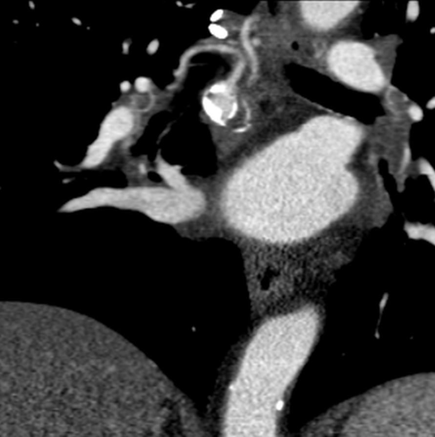 bretwiechmann's tweet photo. Incidental, idiopathic 2.2cm R bronchial artery aneurysm. Tortuosity w 1-vessel rapid inflow/outflow. No shunt/spinal artery seen. #truselect + 016 Fathom + 3mm-12mm #Embold coils #wishIhadObsidio @SIRspecialists @thegestgroup @JafarGolzarian https://t.co/559sFqS7wb