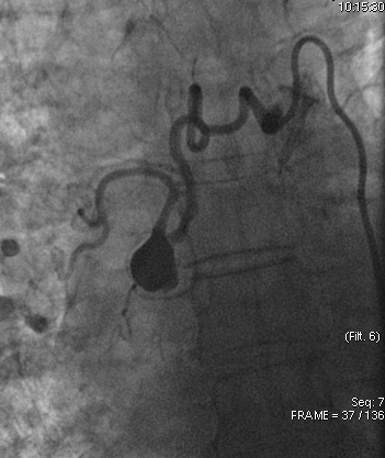 bretwiechmann's tweet photo. Incidental, idiopathic 2.2cm R bronchial artery aneurysm. Tortuosity w 1-vessel rapid inflow/outflow. No shunt/spinal artery seen. #truselect + 016 Fathom + 3mm-12mm #Embold coils #wishIhadObsidio @SIRspecialists @thegestgroup @JafarGolzarian https://t.co/559sFqS7wb