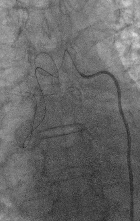 bretwiechmann's tweet photo. Incidental, idiopathic 2.2cm R bronchial artery aneurysm. Tortuosity w 1-vessel rapid inflow/outflow. No shunt/spinal artery seen. #truselect + 016 Fathom + 3mm-12mm #Embold coils #wishIhadObsidio @SIRspecialists @thegestgroup @JafarGolzarian https://t.co/559sFqS7wb