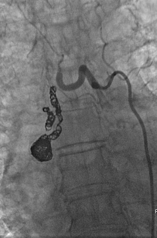 bretwiechmann's tweet photo. Incidental, idiopathic 2.2cm R bronchial artery aneurysm. Tortuosity w 1-vessel rapid inflow/outflow. No shunt/spinal artery seen. #truselect + 016 Fathom + 3mm-12mm #Embold coils #wishIhadObsidio @SIRspecialists @thegestgroup @JafarGolzarian https://t.co/559sFqS7wb