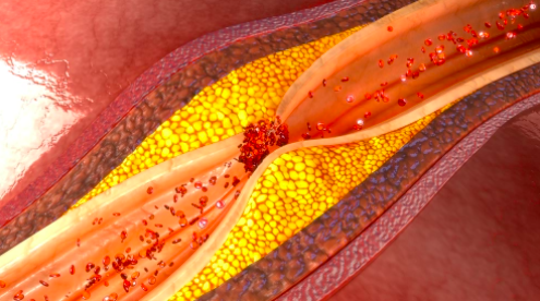 #PCSK9inhibitors are a class of drugs prescribed to tx resistant #HighCholesterol. But they're inaccessible to many.
A team has developed an #OralMedication that works similar to PCSK9 inhibitors. In a #ClinicalTrial, the drug reduced #LDL  by 40% on avg

hubs.li/Q01HV5-X0