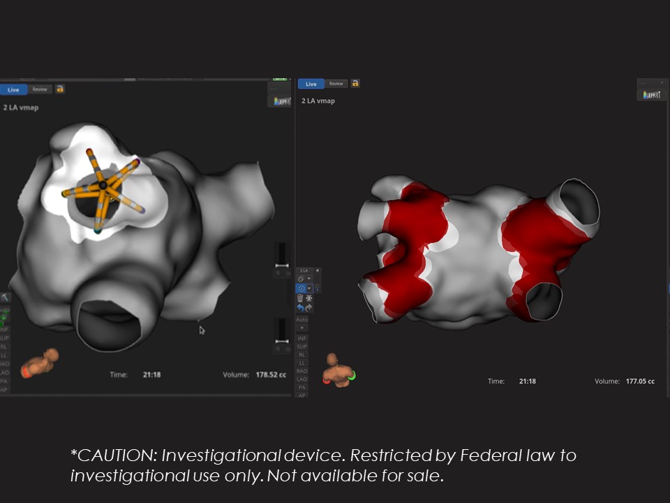 BSC_EU_Heart's tweet photo. New modality like PFA, new way of thinking in mapping integration. Hear @Mel_Gunawardene' s presentation on a prototype of FARAVIEW™** mapping integration with real case example at the @HRSonline on Saturday, 1:30 Rhythm Theater #2. To learn more on #PFA: https://t.co/yZbyc1r2af https://t.co/QNUeFLZnG9