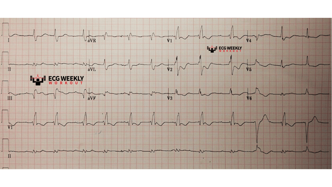 ECGWeekly On Twitter A Patient Presents To The Emergency Department ecgweekly-on-twitter-a-patient-presents-to-the-emergency-department