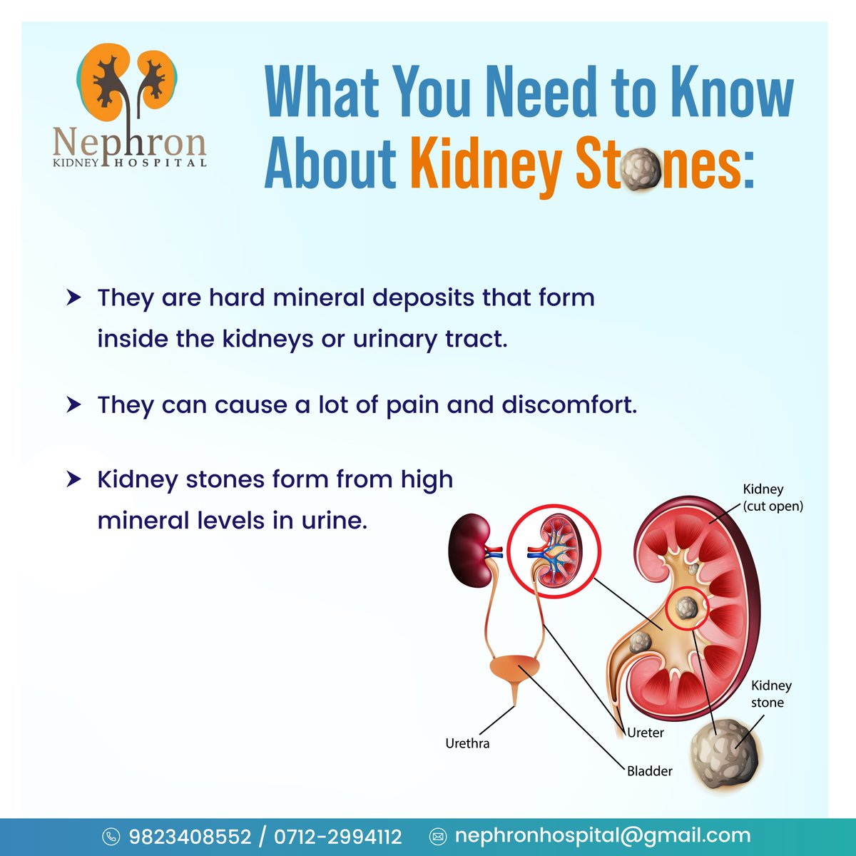 What you need to know about Kidney Stones:

#nephronhospitalnagpur #bestdialysiscenterinnagpur #dialysisunitnagpur #dialysiscenterinnagpur #bestkidneyhospitalinnagpur #kidneyhospitalinnagpur #
#KidneyStones #RenalCalcul #StoneInKidney #Urolithiasis #PainfulUrination